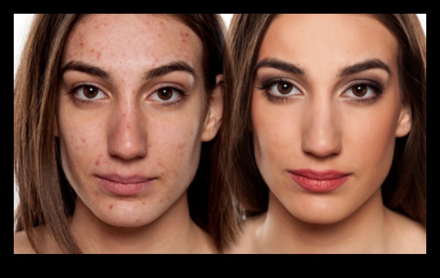 Concealer and Acne: How to Conceal Blemishes Without Aggravating Them