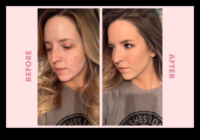 Everyday Makeup for Scars: Tips for Concealing and Enhancing Confidence