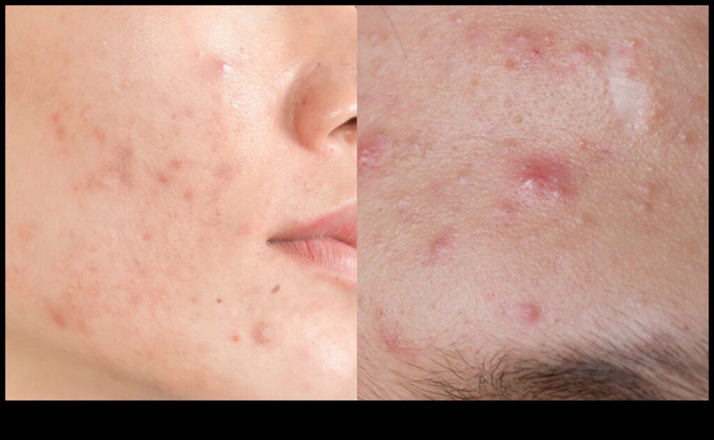 Powder and Acne A Guide to Controlling Shine Without Aggravating Blemishes 1