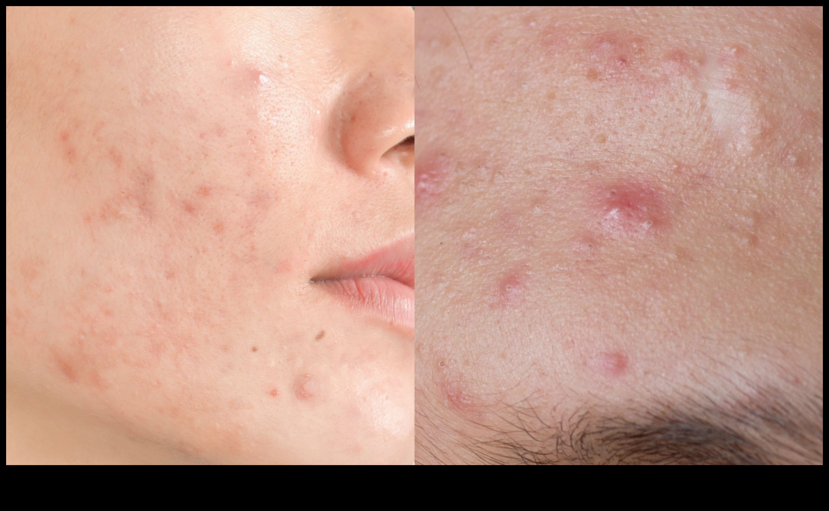 Powder and Acne: How to Control Shine Without Aggravating Blemishes