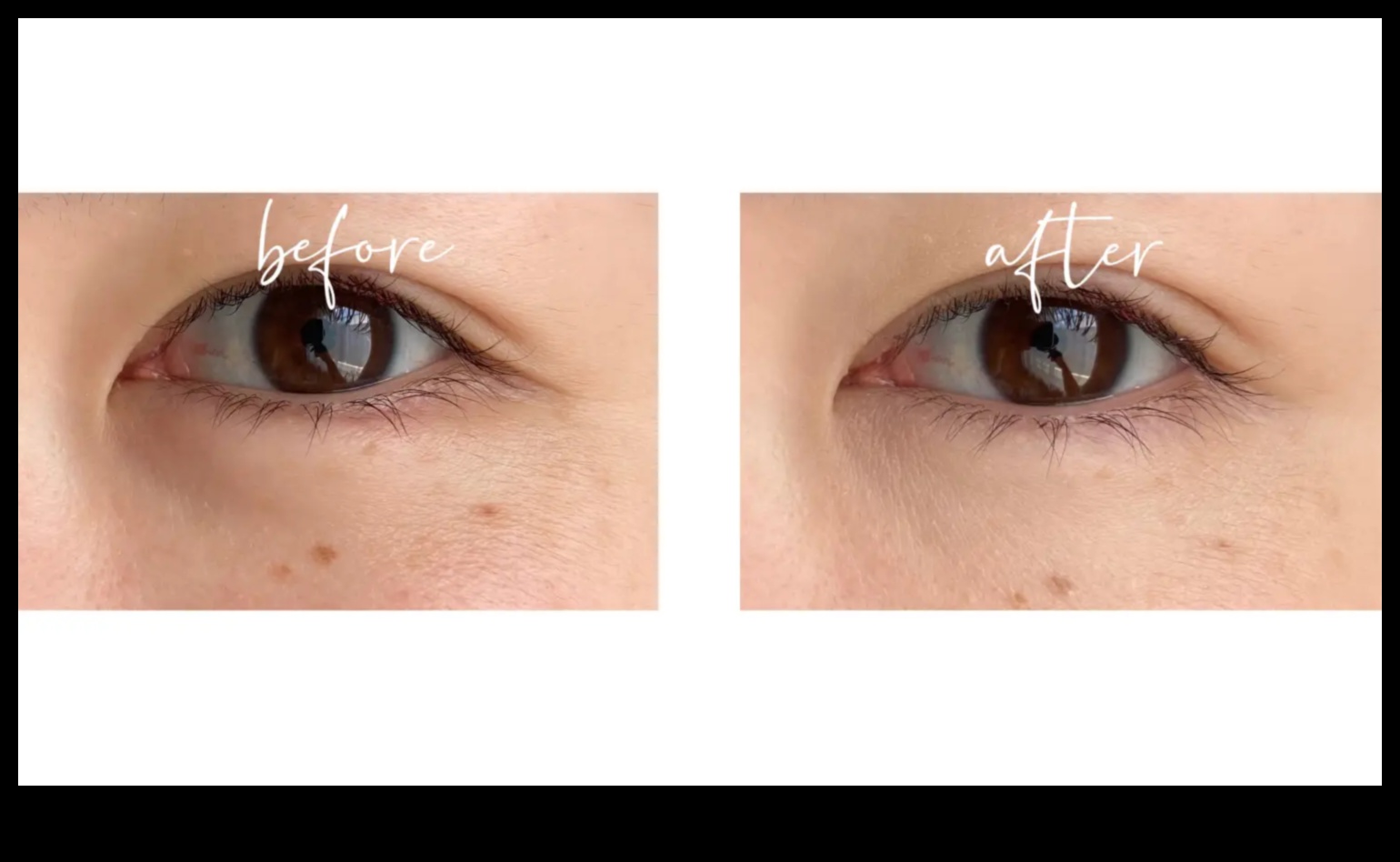 Undereye Elixirs: Banishing Dark Circles with the Perfect Concealer